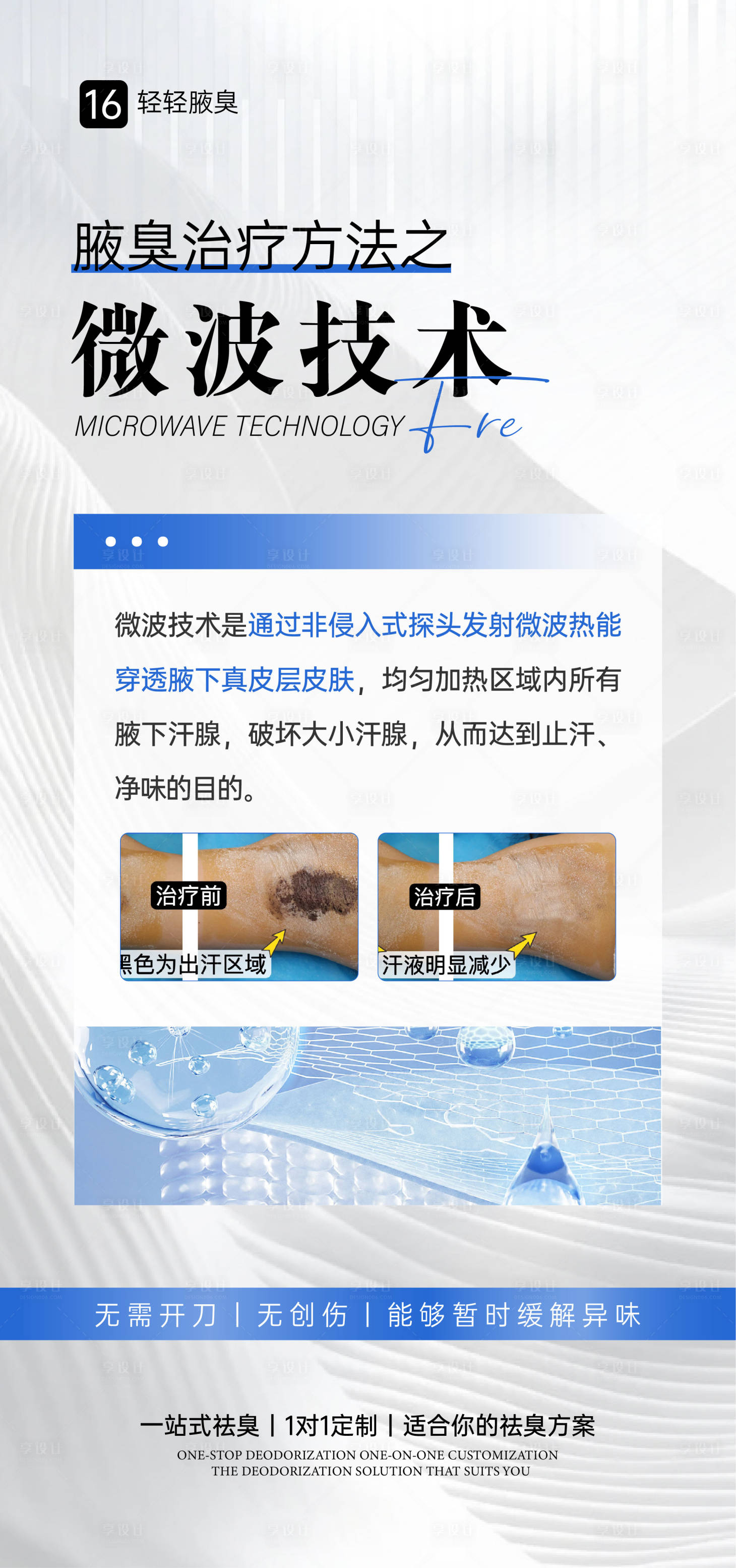 源文件下载【腋臭微波手术海报】编号：70120031314449664