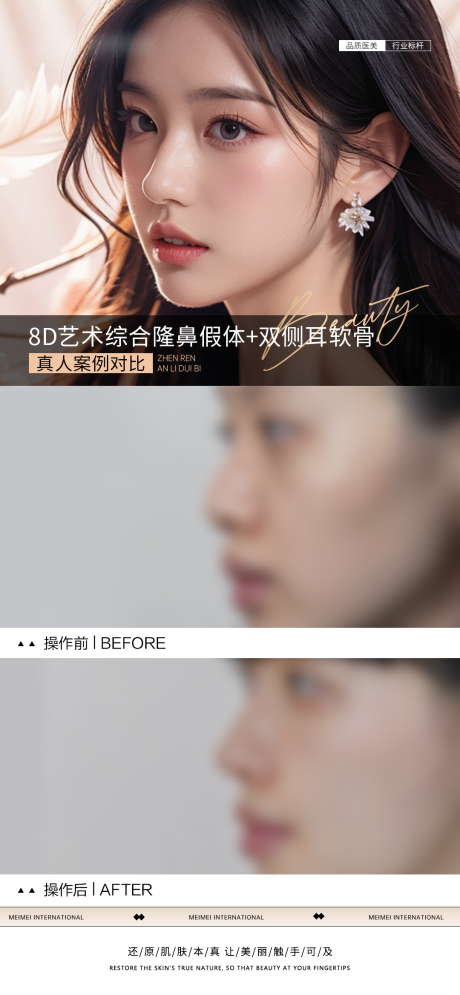 源文件下载【医美隆鼻案例对比海报】编号：72680031660641315