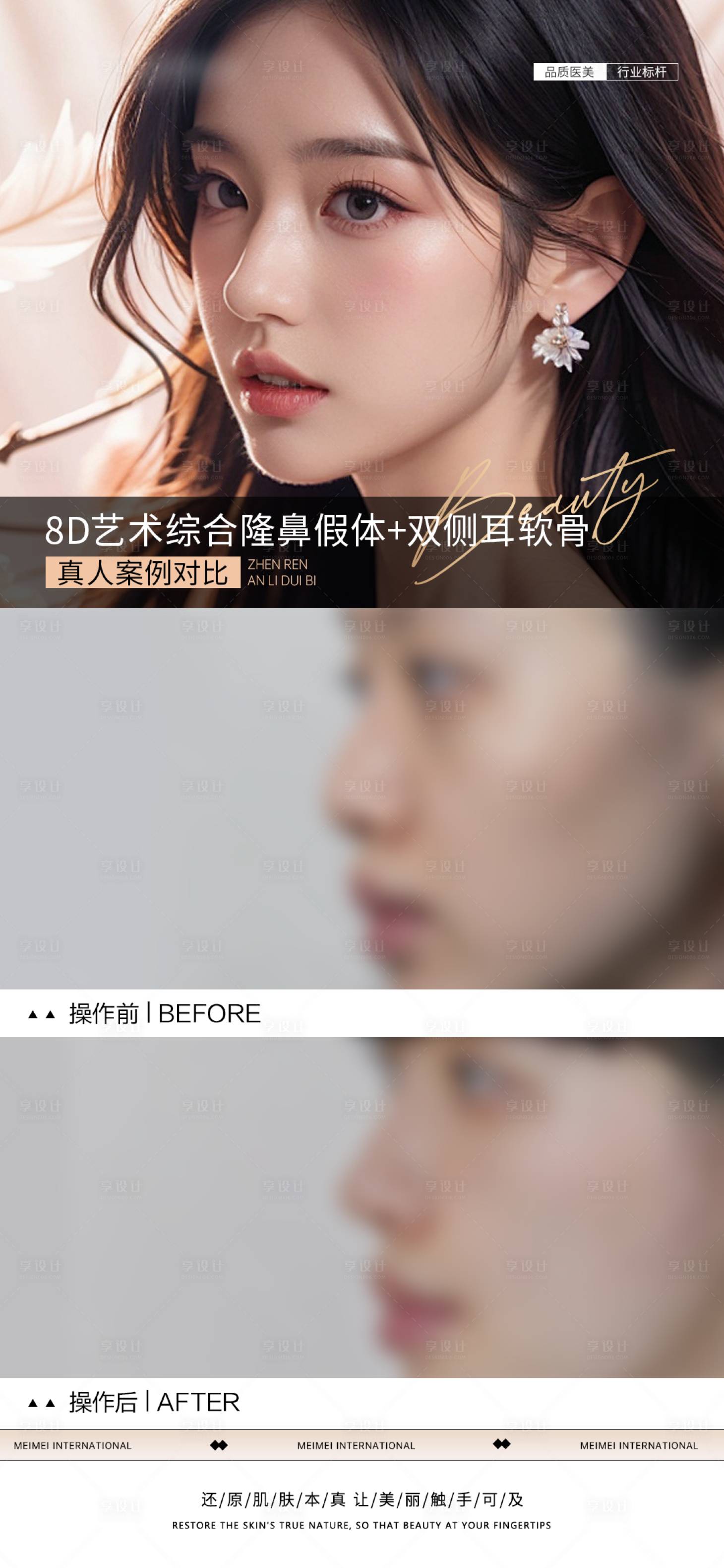 源文件下載【享設計】搜索編號：72680031660641315【醫美隆鼻案例對比海報】