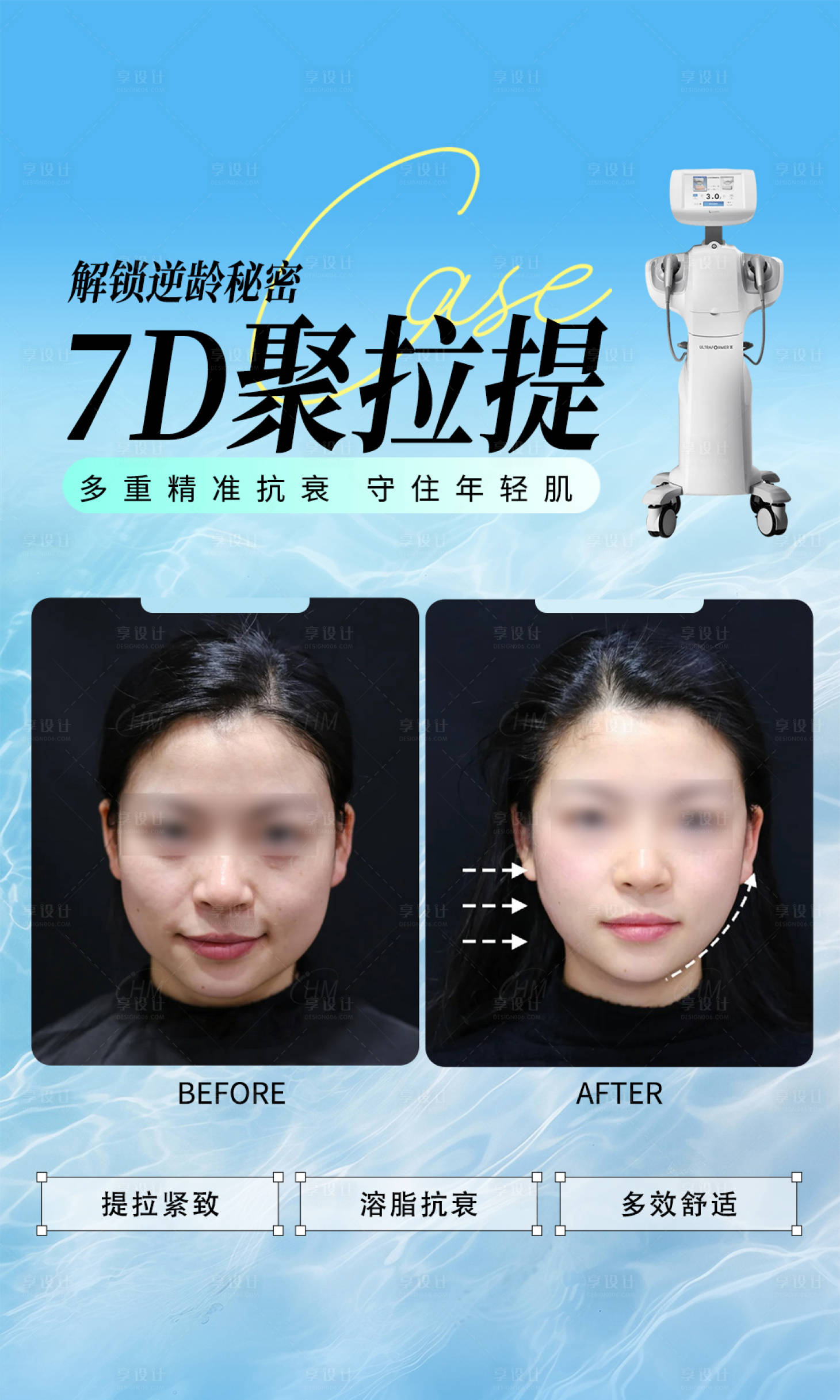 源文件下載【醫(yī)美聚拉提抗衰案例海報(bào)】編號(hào)：73080031180545411