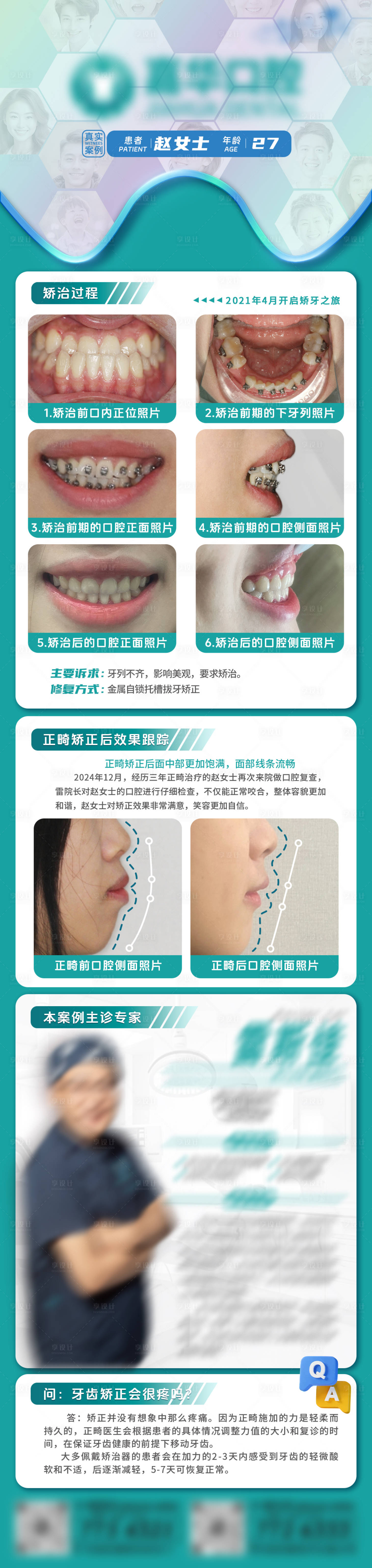源文件下载【口腔矫正案例分析正畸案例分享】编号：41240031731669792