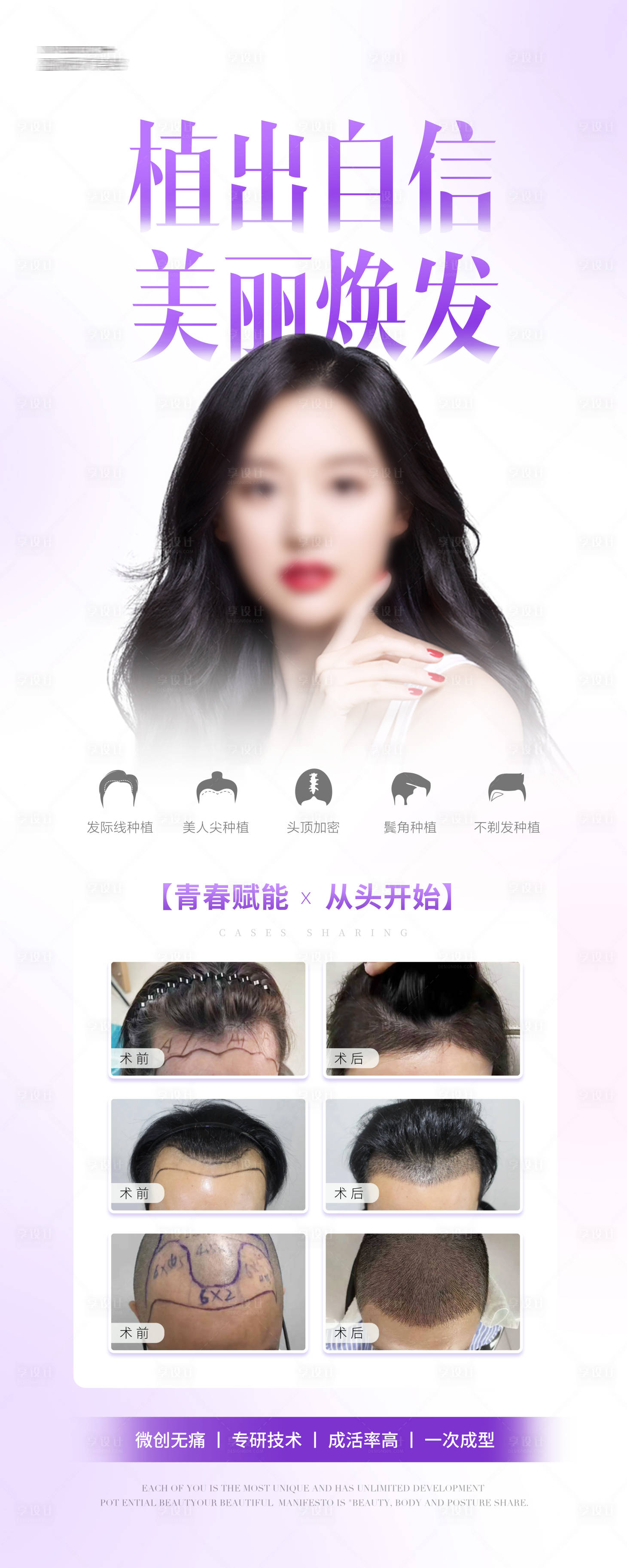 源文件下載【享設計】搜索編號：13800031862084549【植發易拉寶展架】