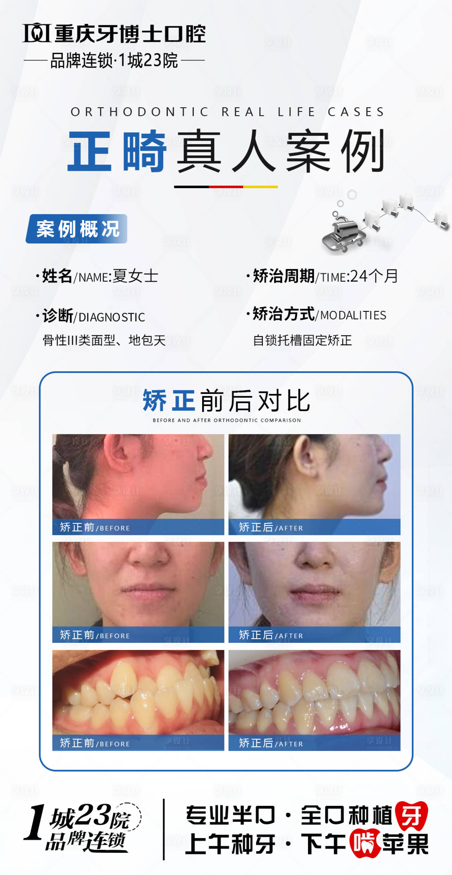 源文件下载【享设计】搜索编号：35420031935811727【正畸案例】