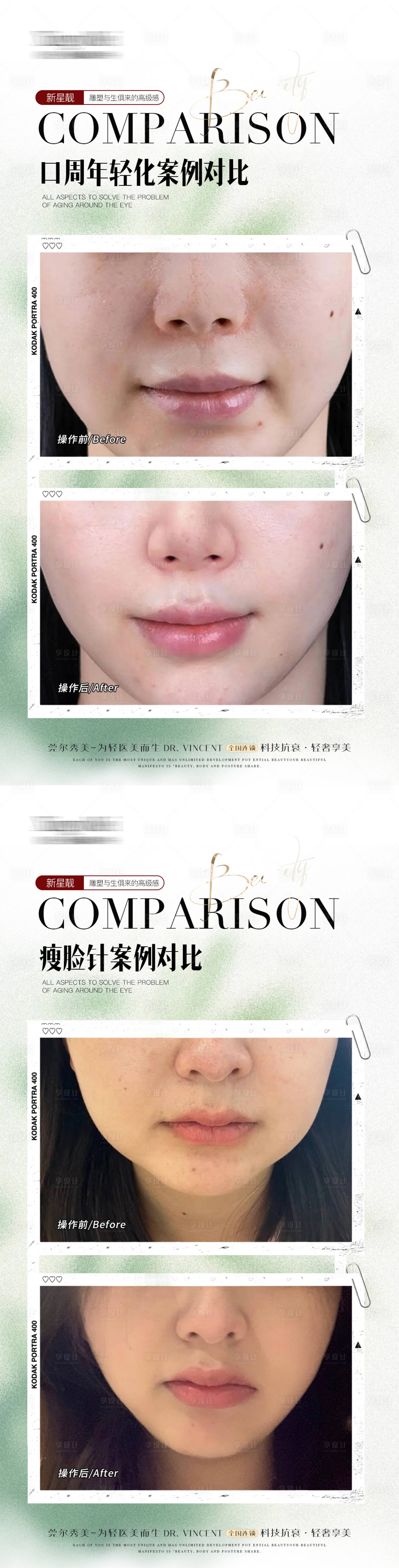 源文件下载【微整案例】编号：59450032182868808
