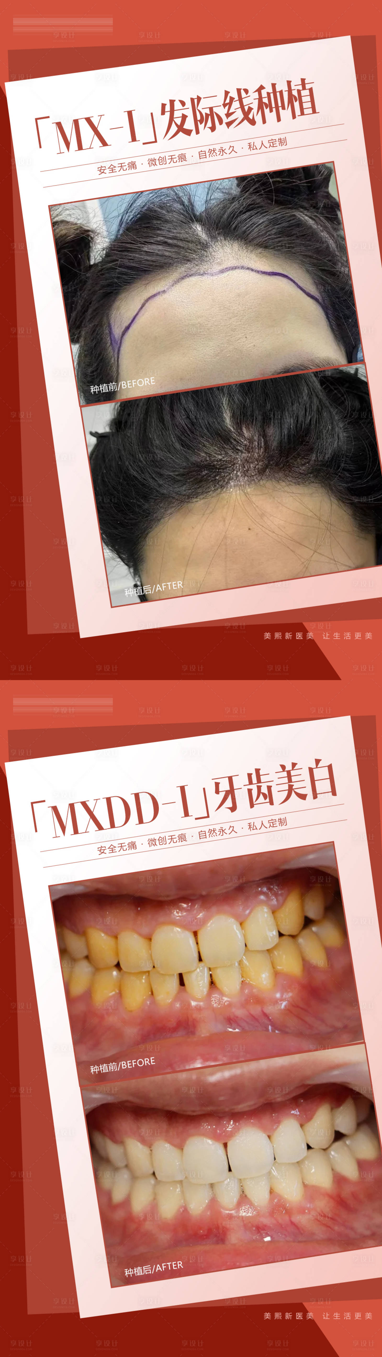 源文件下載【享設計】搜索編號：32420031913877810【口腔植發案例】