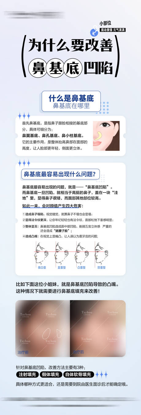 源文件下載【鼻基底凹陷科普】編號(hào)：35020031892836876