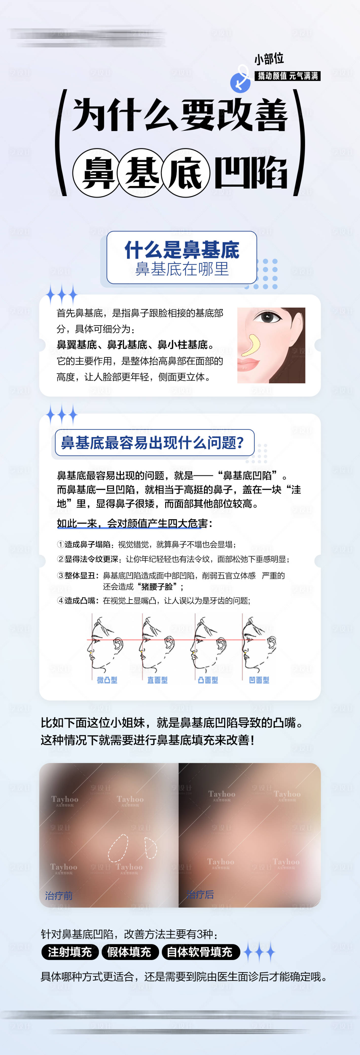 源文件下载【享设计】搜索编号：35020031892836876【鼻基底凹陷科普】