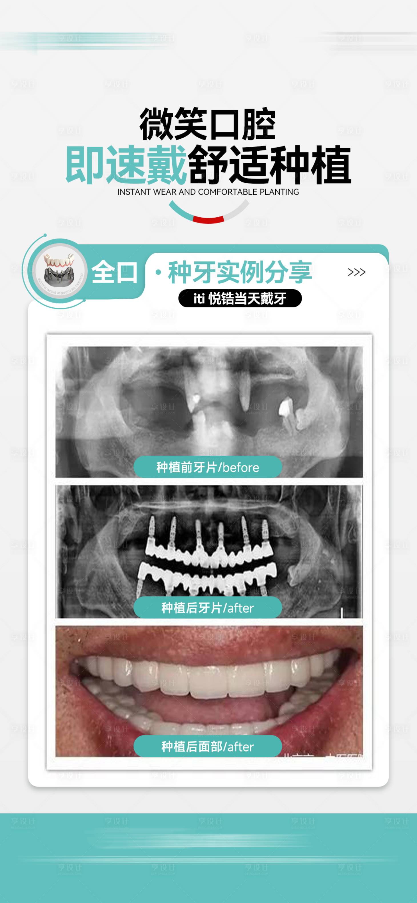 源文件下載【享設計】搜索編號：99560032168181885【口腔種植牙案例對比圖】