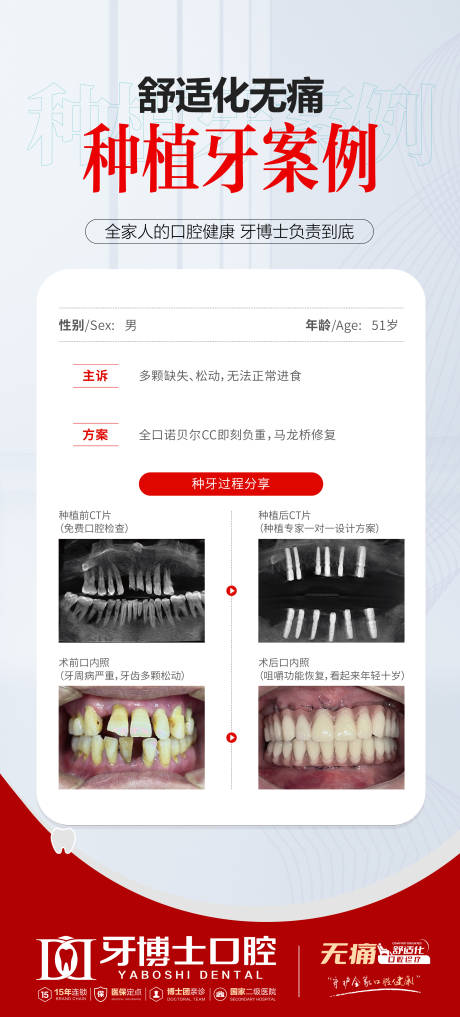 源文件下載【享設計】搜索編號：69080032236322070【舒適化種植牙案例】
