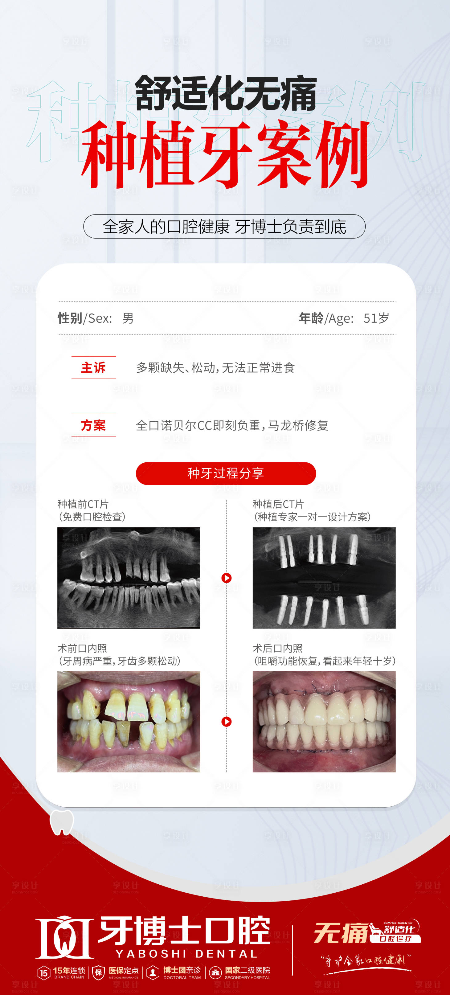 源文件下载【享设计】搜索编号：69080032236322070【舒适化种植牙案例】
