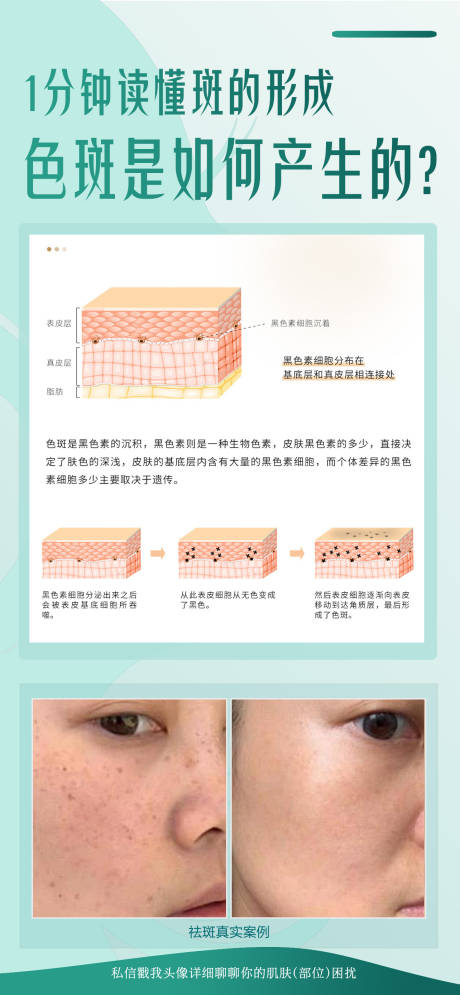 源文件下载【享设计】搜索编号：51920032453496665【色斑是如何产生的】