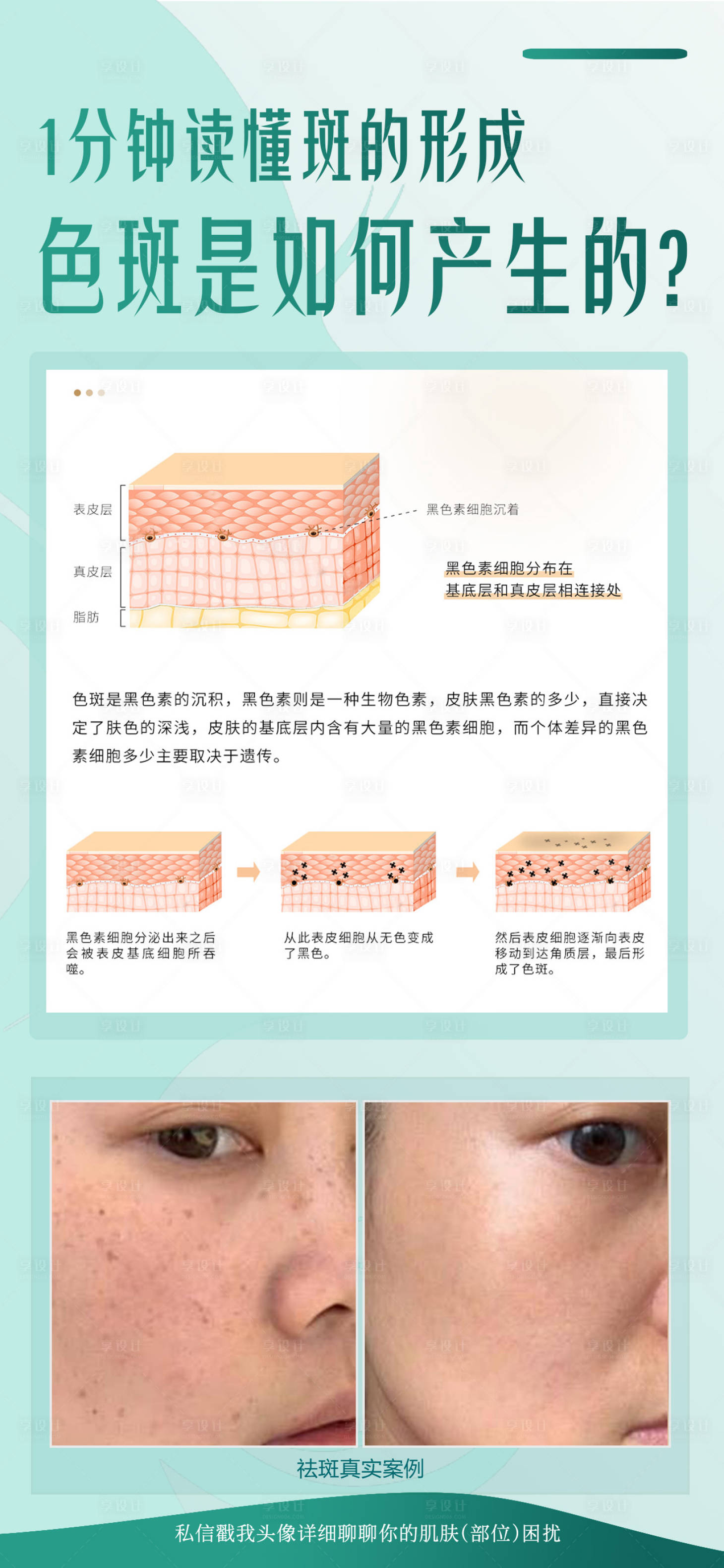 源文件下载【享设计】搜索编号：51920032453496665【色斑是如何产生的】