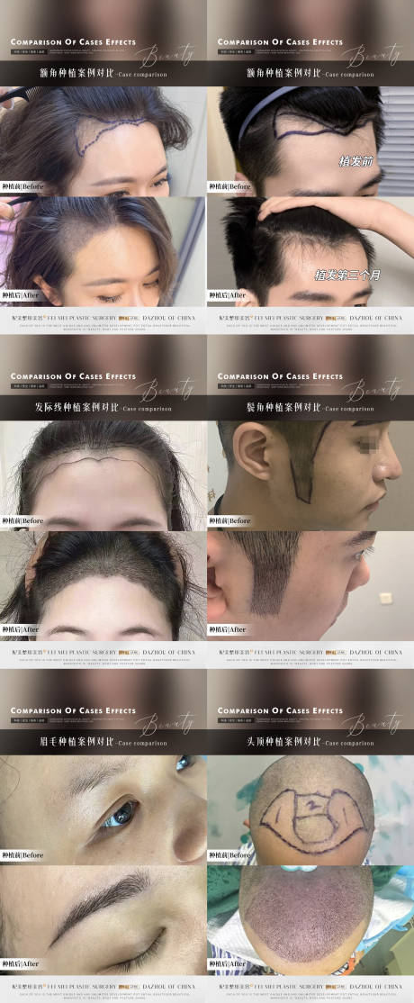 源文件下载【享设计】搜索编号：39930032722202329【植发案例】
