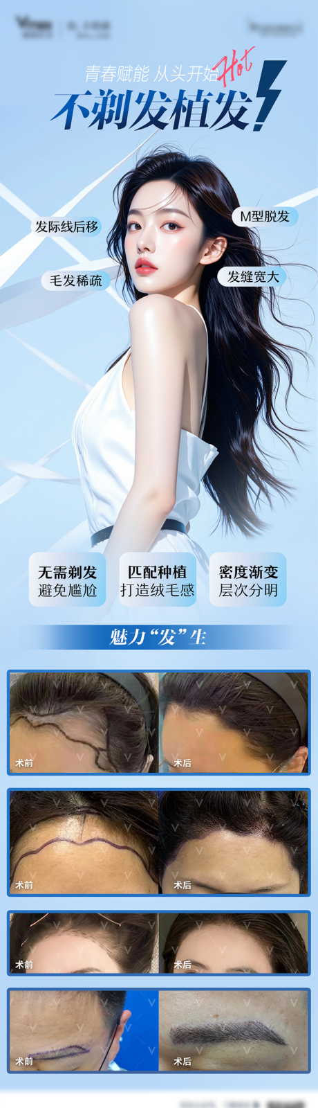 源文件下載【享設計】搜索編號：41690032589386846【醫美無痕植發案例海報宣傳活動】