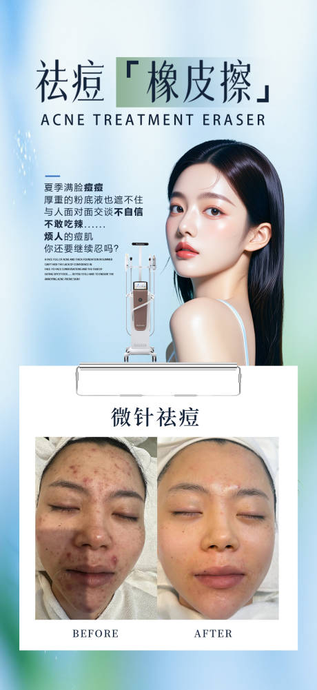 源文件下載【享設計】搜索編號：74000032366604998【微針祛痘案例海報】