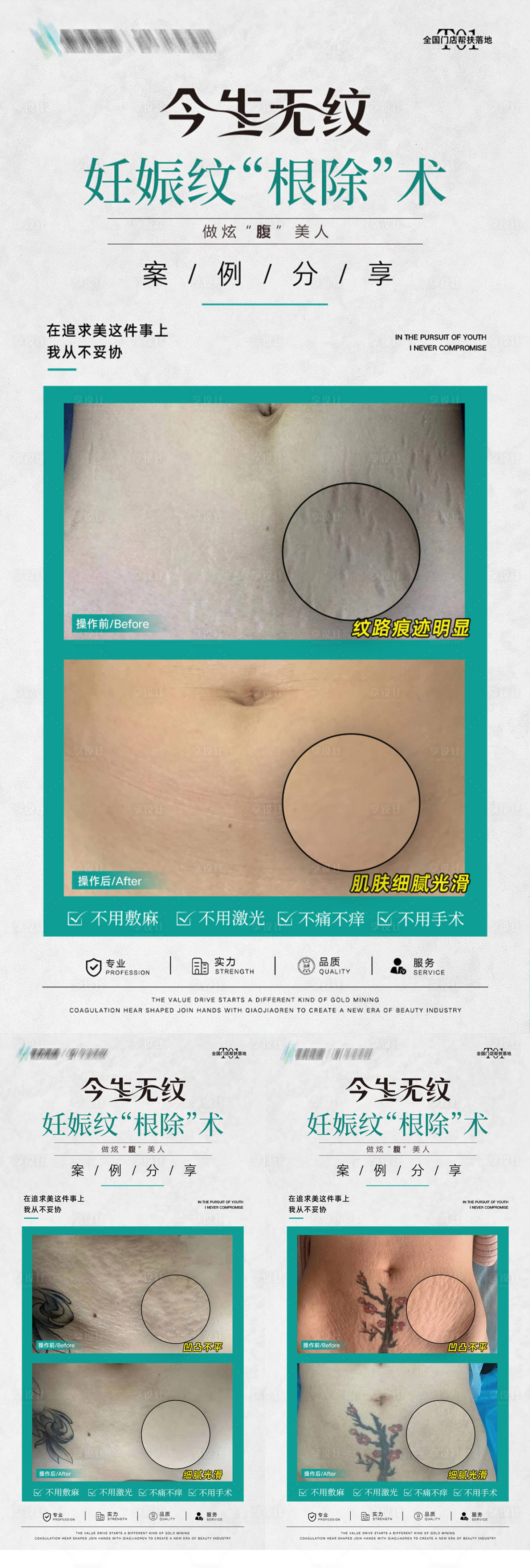 源文件下載【享設(shè)計】搜索編號：33560032654227062【妊娠紋對比海報】