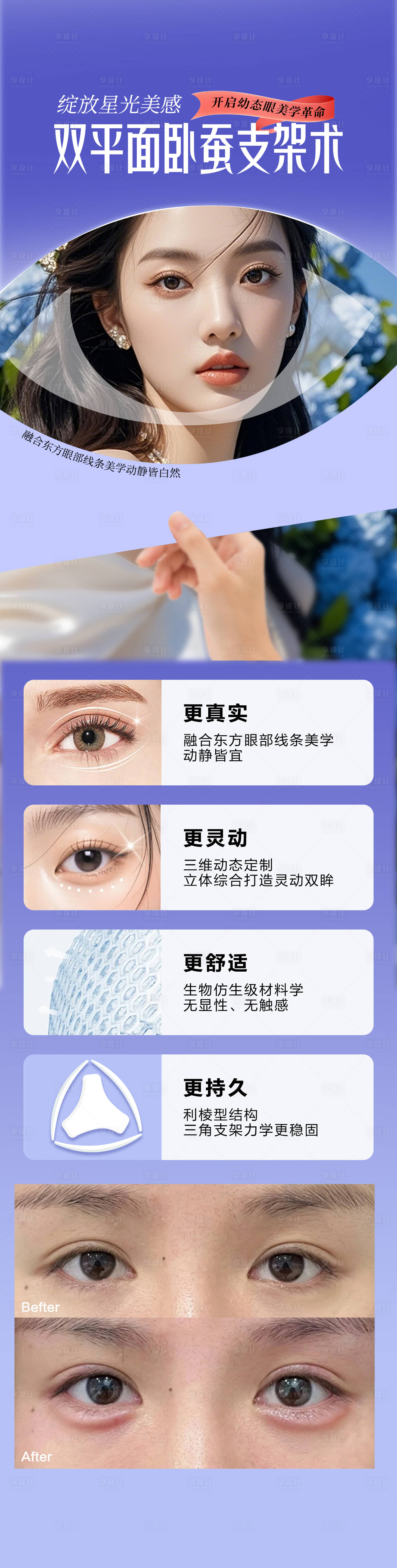 源文件下載【享設計】搜索編號：32390032491424731【雙平面臥蠶支架術】