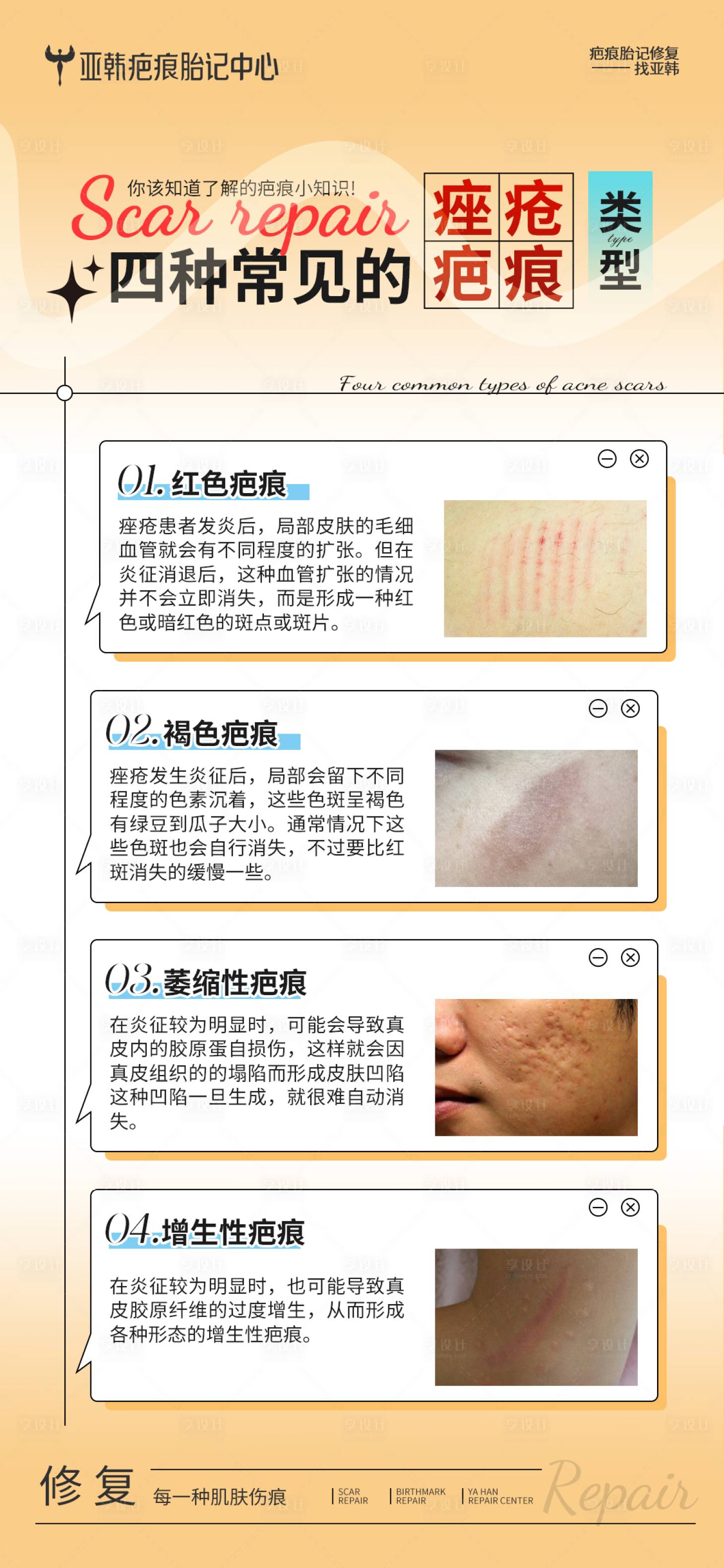 源文件下载【享设计】搜索编号：23240032734023304【四种常见的痤疮疤痕类型海报】