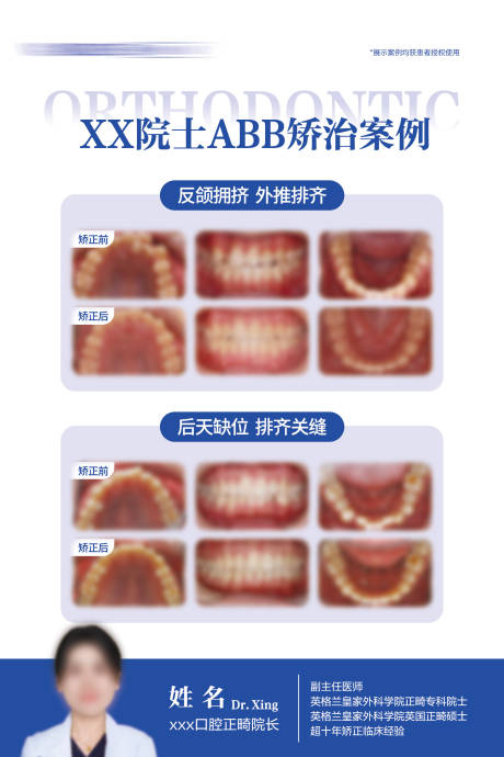 源文件下载【享设计】搜索编号：35970032747225076【牙齿矫正案例对比海报展板】