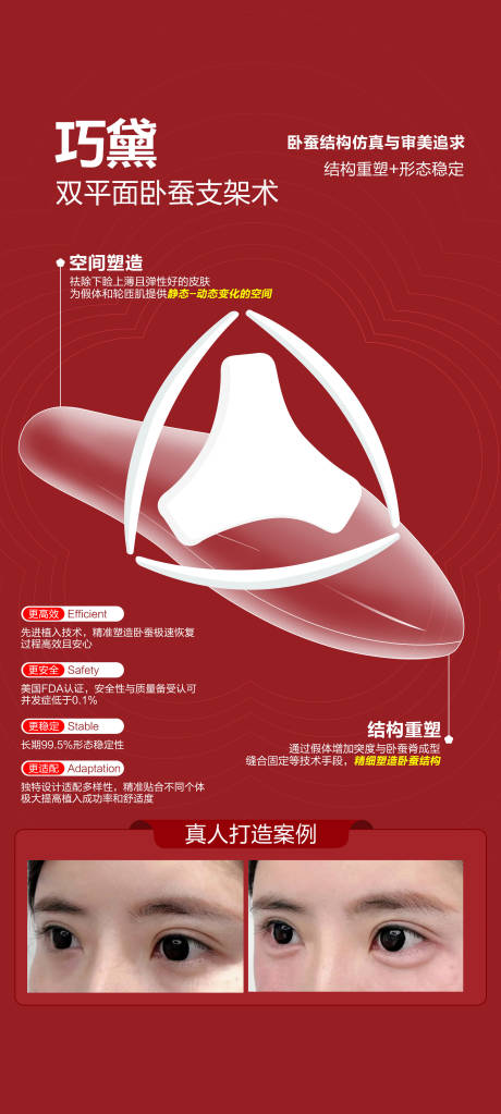 源文件下載【享設計】搜索編號：91900032491435892【雙平面臥蠶支架術】