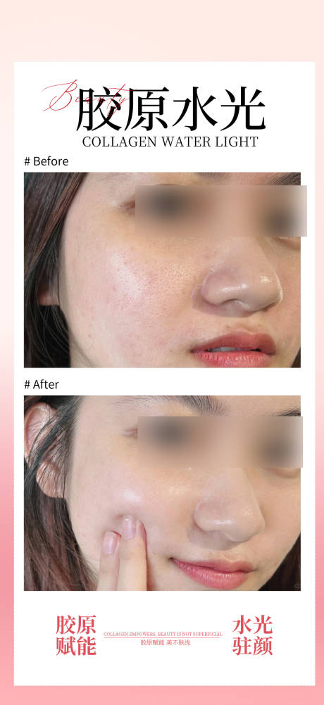 源文件下载【享设计】搜索编号：16220033311013483【医美胶原水光案例海报】