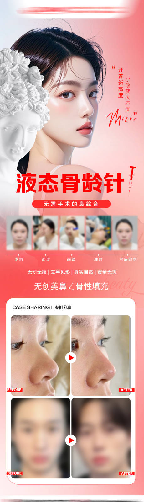 源文件下載【享設(shè)計(jì)】搜索編號(hào)：56120032982121364【玻尿酸隆鼻】