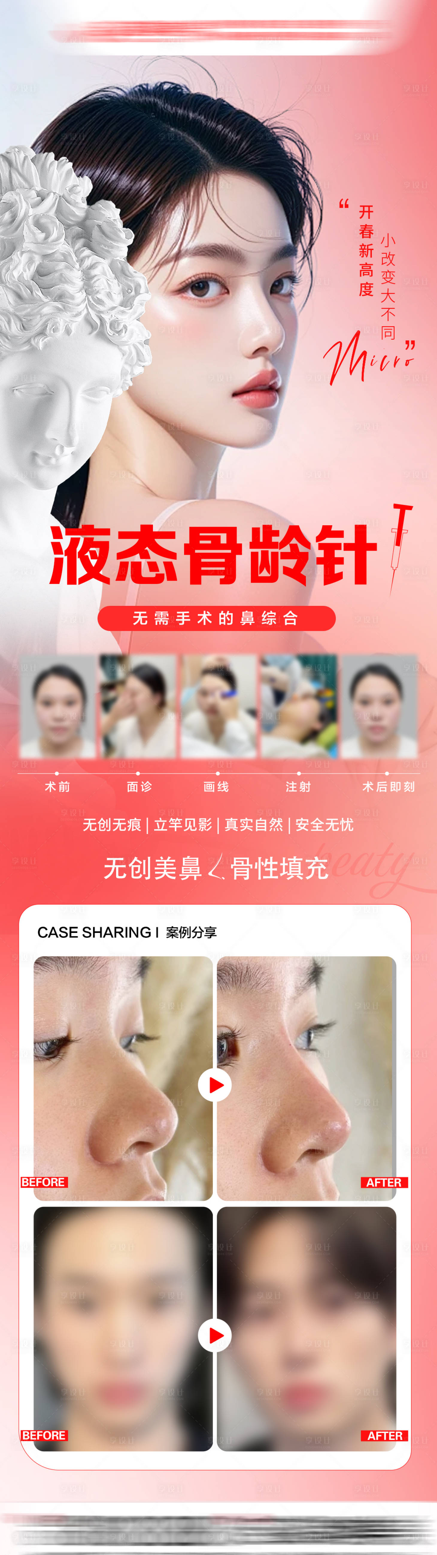 源文件下載【享設計】搜索編號：56120032982121364【玻尿酸隆鼻】