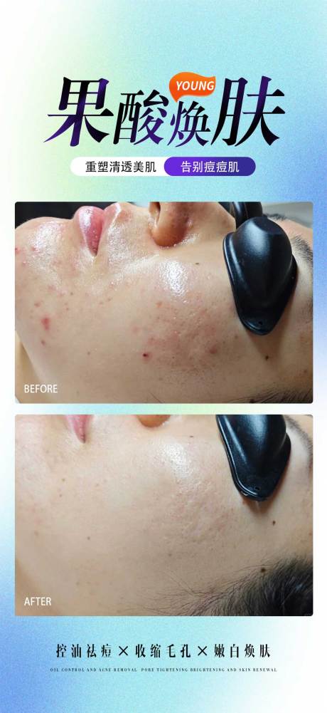 源文件下载【享设计】搜索编号：81090033593908884【果酸焕肤案例】