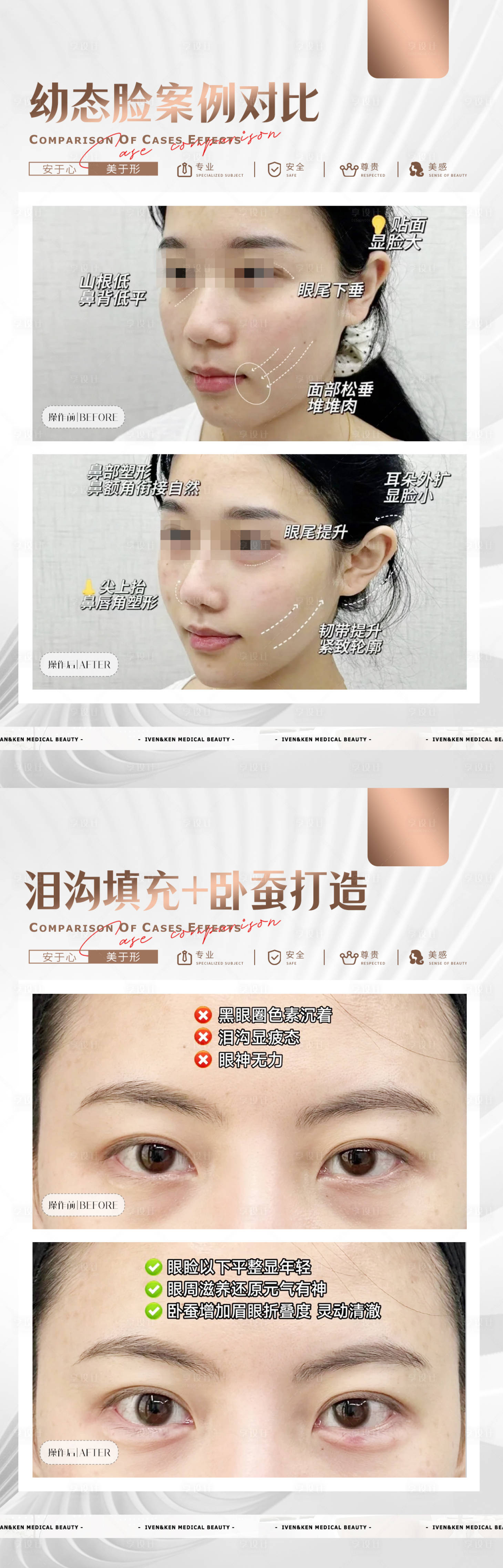 源文件下载【享设计】搜索编号：30350033791493461【幼态脸泪沟案例】