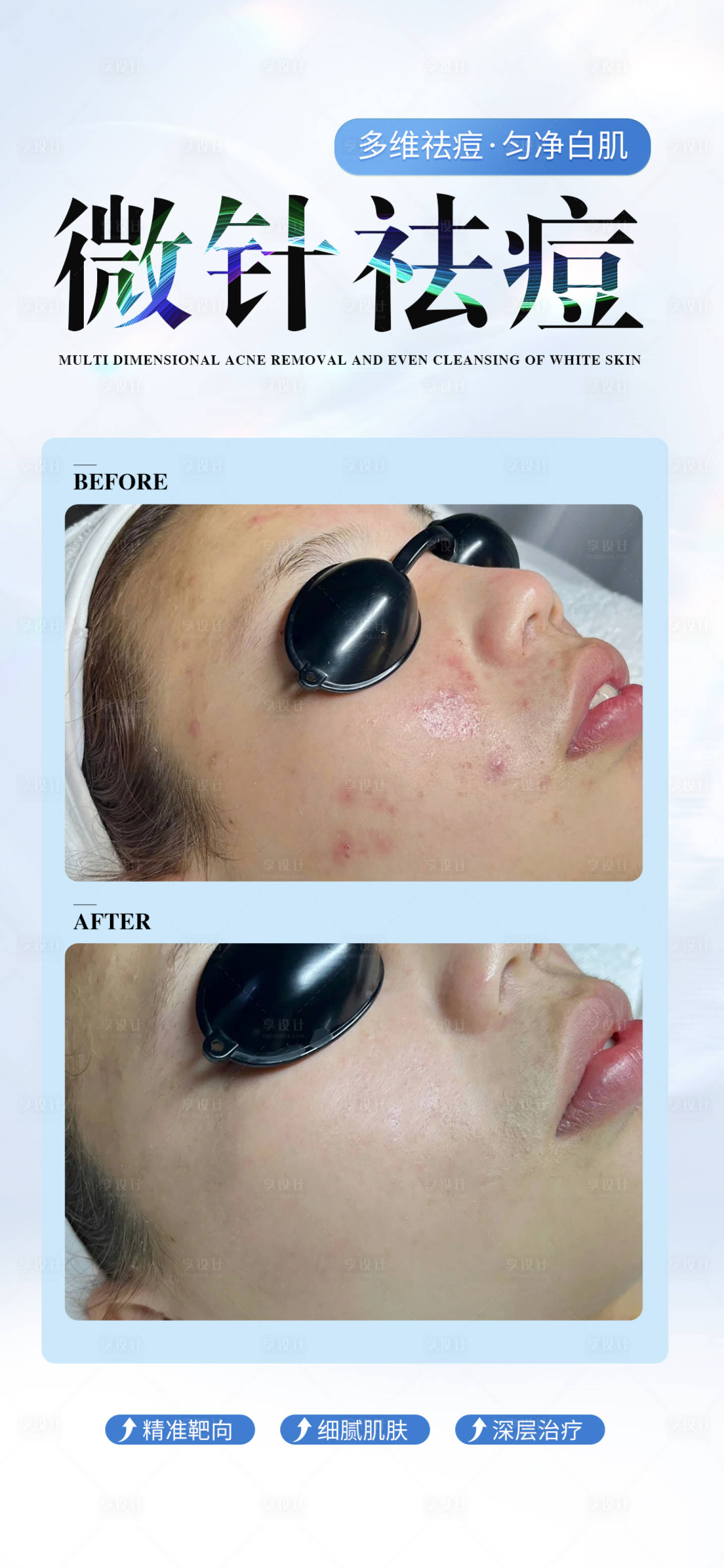 源文件下载【享设计】搜索编号：98250033403891545【微针祛痘宣传海报】