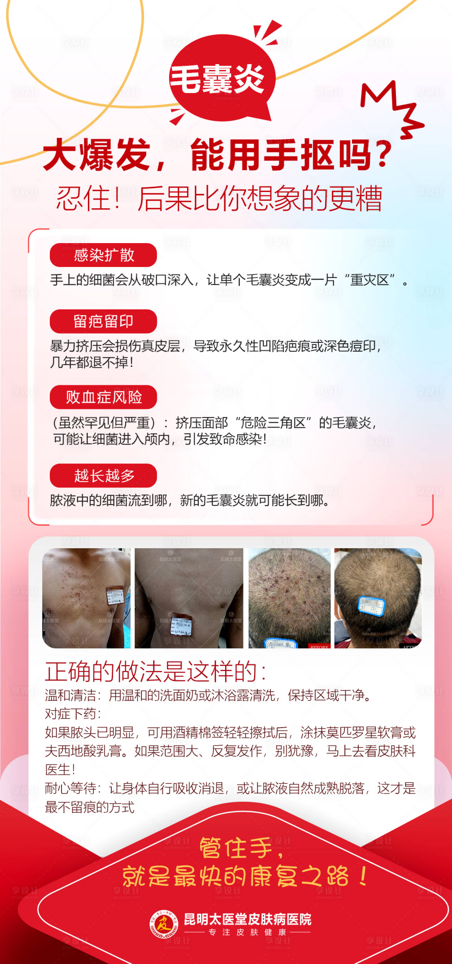 源文件下载【享设计】搜索编号：54600033687847712【毛囊炎科普海报】