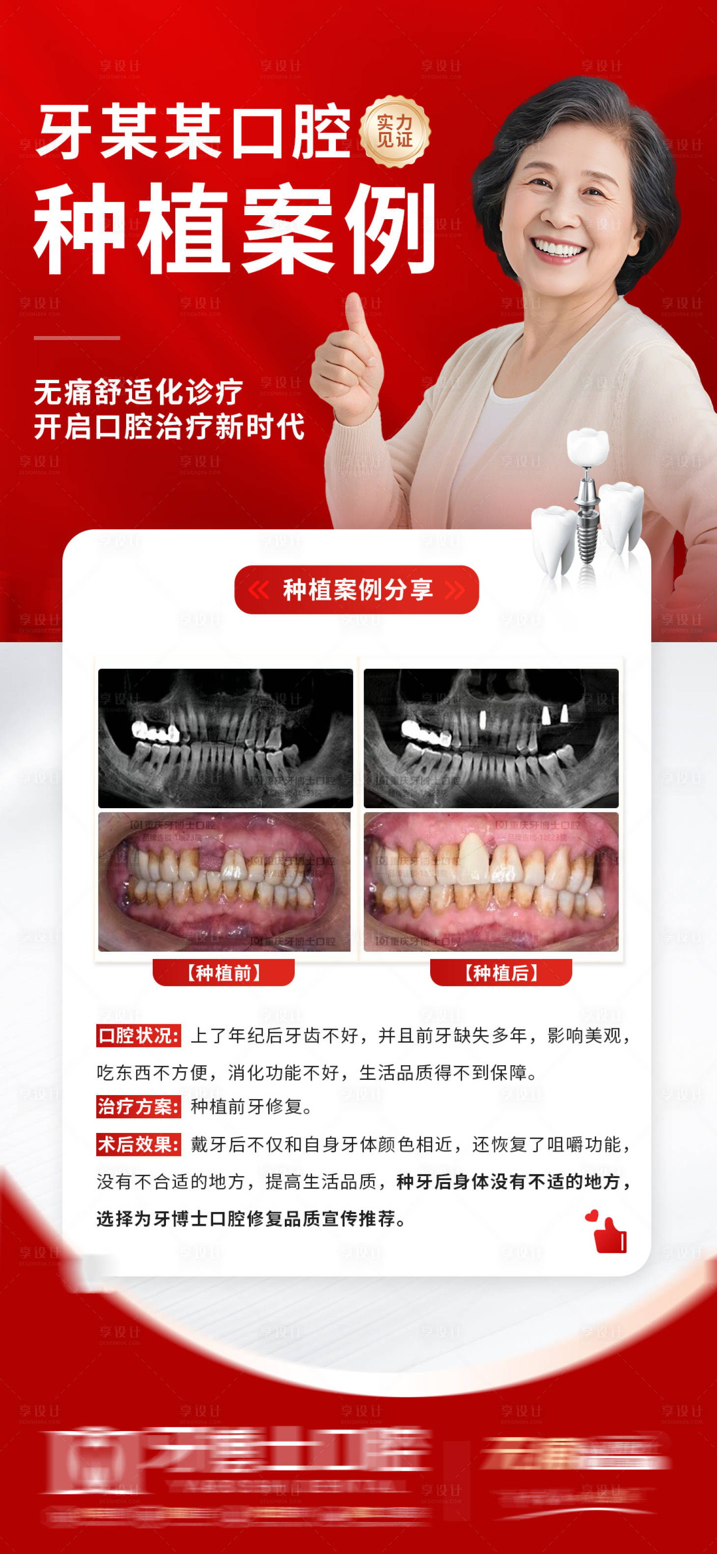 源文件下载【享设计】搜索编号：93990033486337482【种植牙口腔科普案例海报】