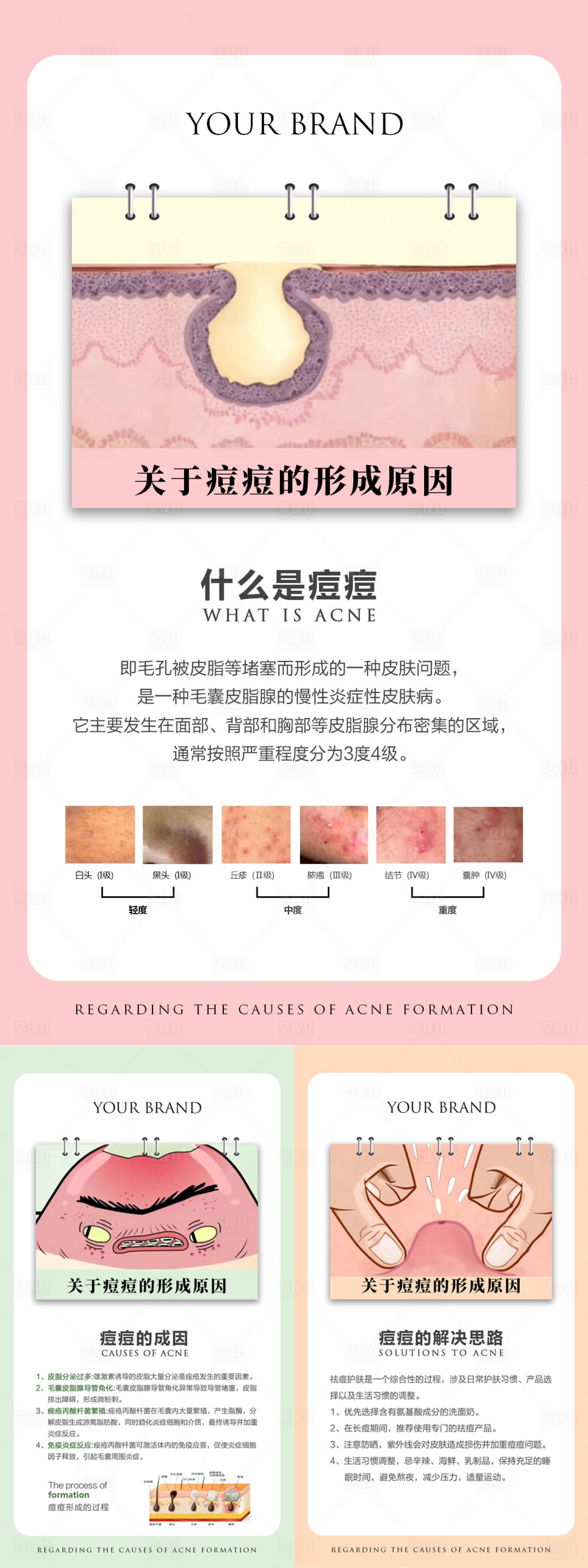 源文件下载【享设计】搜索编号：41420033782479863【痘痘的形成原因海报】