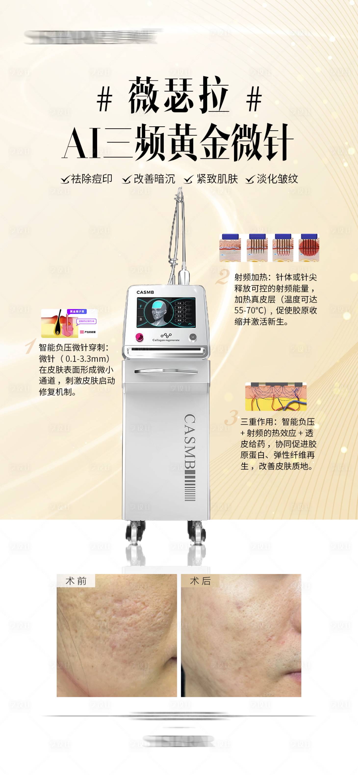 源文件下载【享设计】搜索编号：93420034079251257【薇瑟拉AI三频黄金微针案例宣传海报】