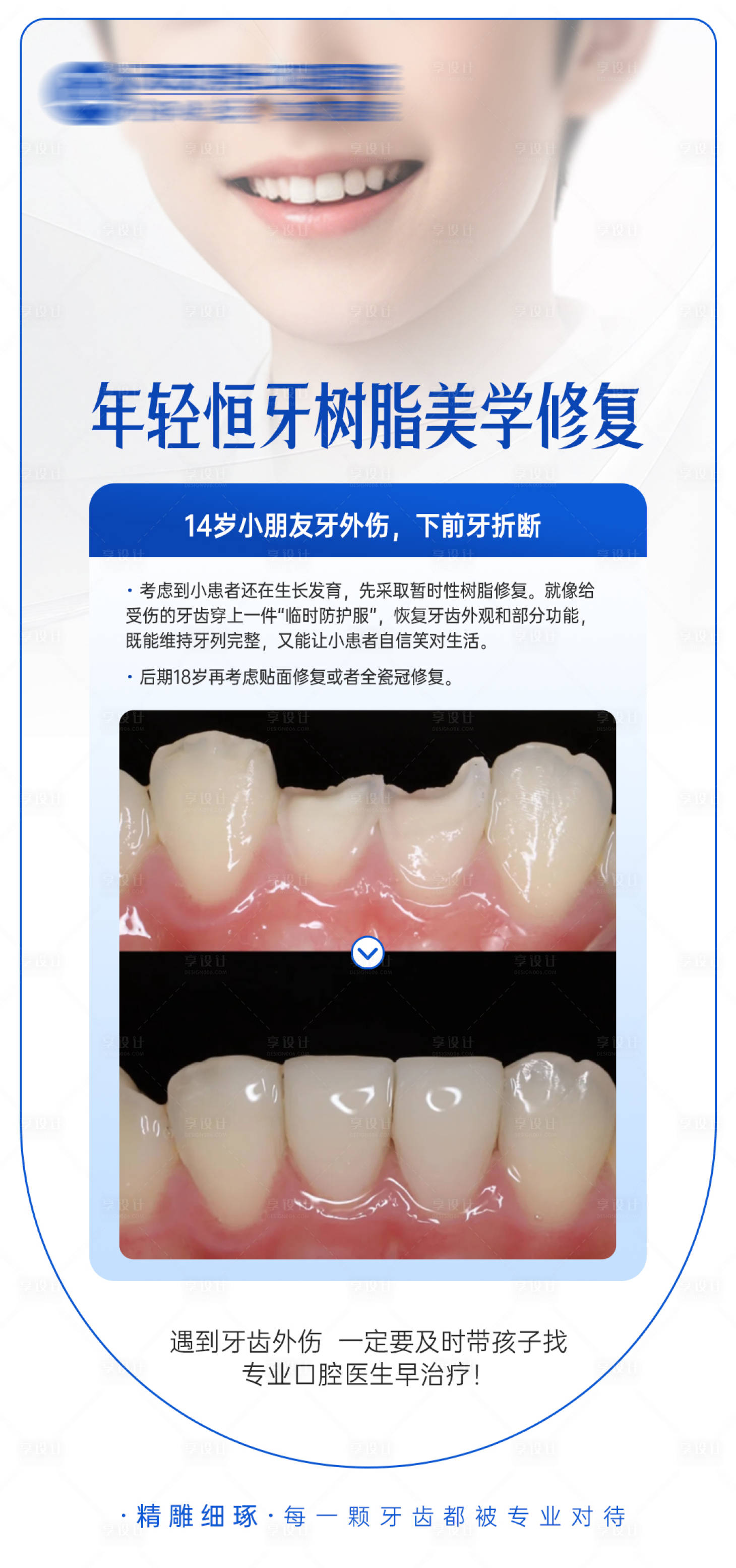 源文件下载【享设计】搜索编号：76880033950583730【年轻恒牙树脂美学修复海报】