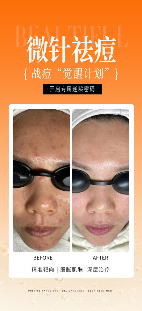 源文件下载【享设计】搜索编号：42140033821499385【祛痘案例】