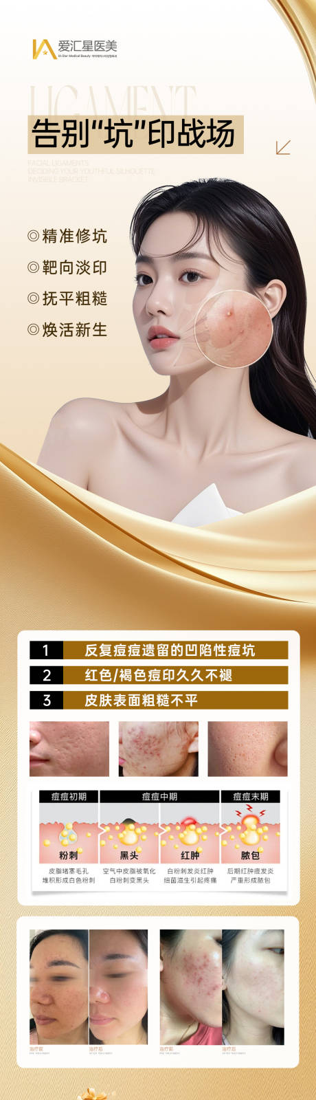 源文件下载【享设计】搜索编号：92100034217245814【祛痘海报】