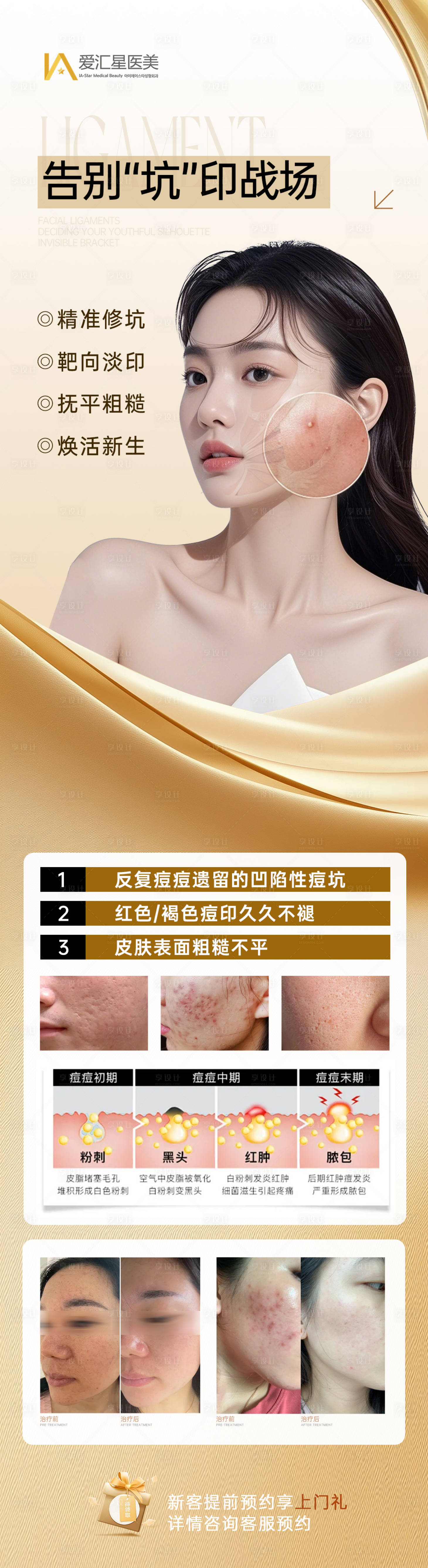 源文件下载【享设计】搜索编号：92100034217245814【祛痘海报】