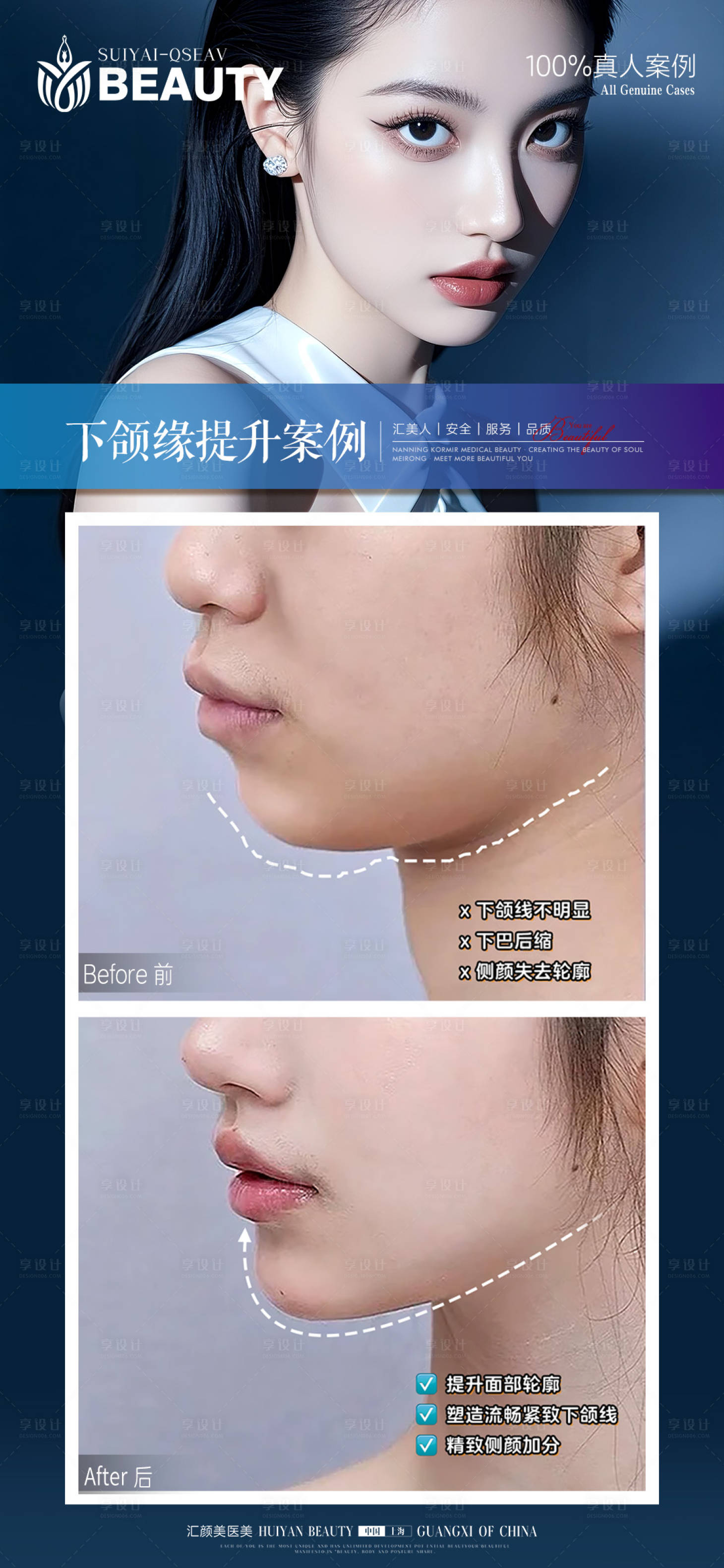 源文件下载【享设计】搜索编号：79760034130593160【下颌缘提升案例海报】