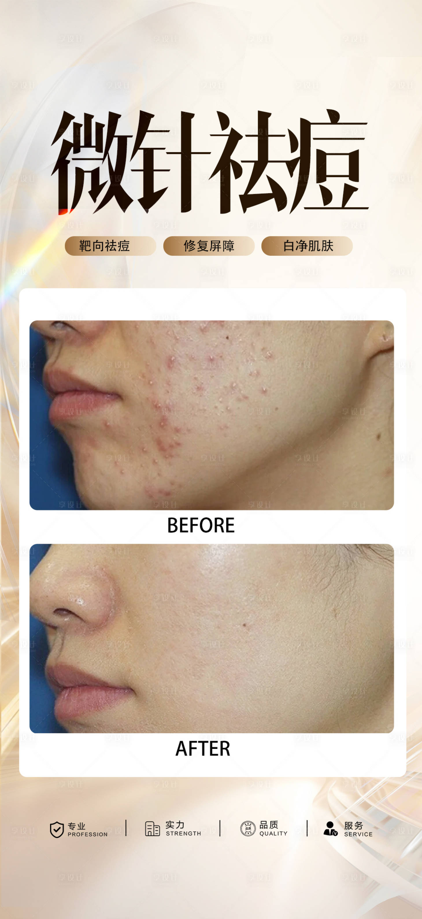 源文件下载【享设计】搜索编号：42830033821509884【祛痘案例】