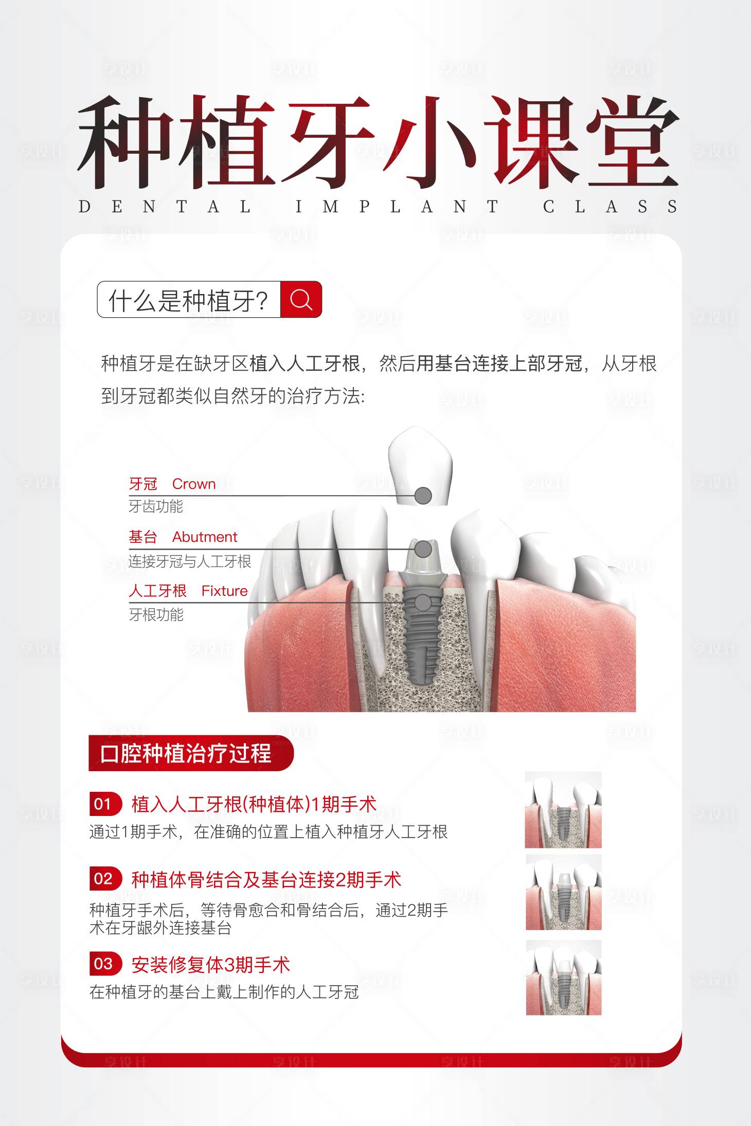 源文件下载【享设计】搜索编号：63970033921357705【种植牙简约科普海报】