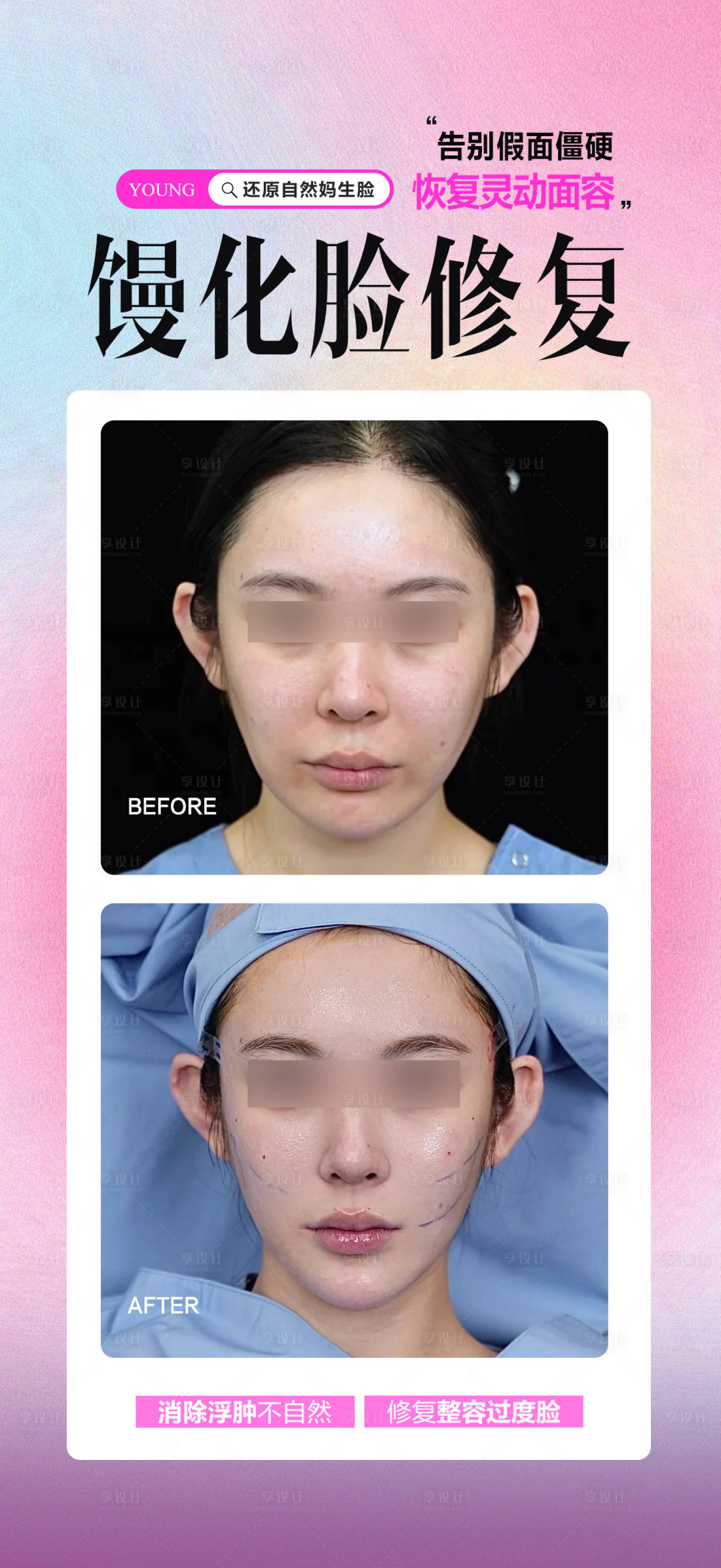 源文件下载【享设计】搜索编号：48930034279608683【馒化脸修复案例】