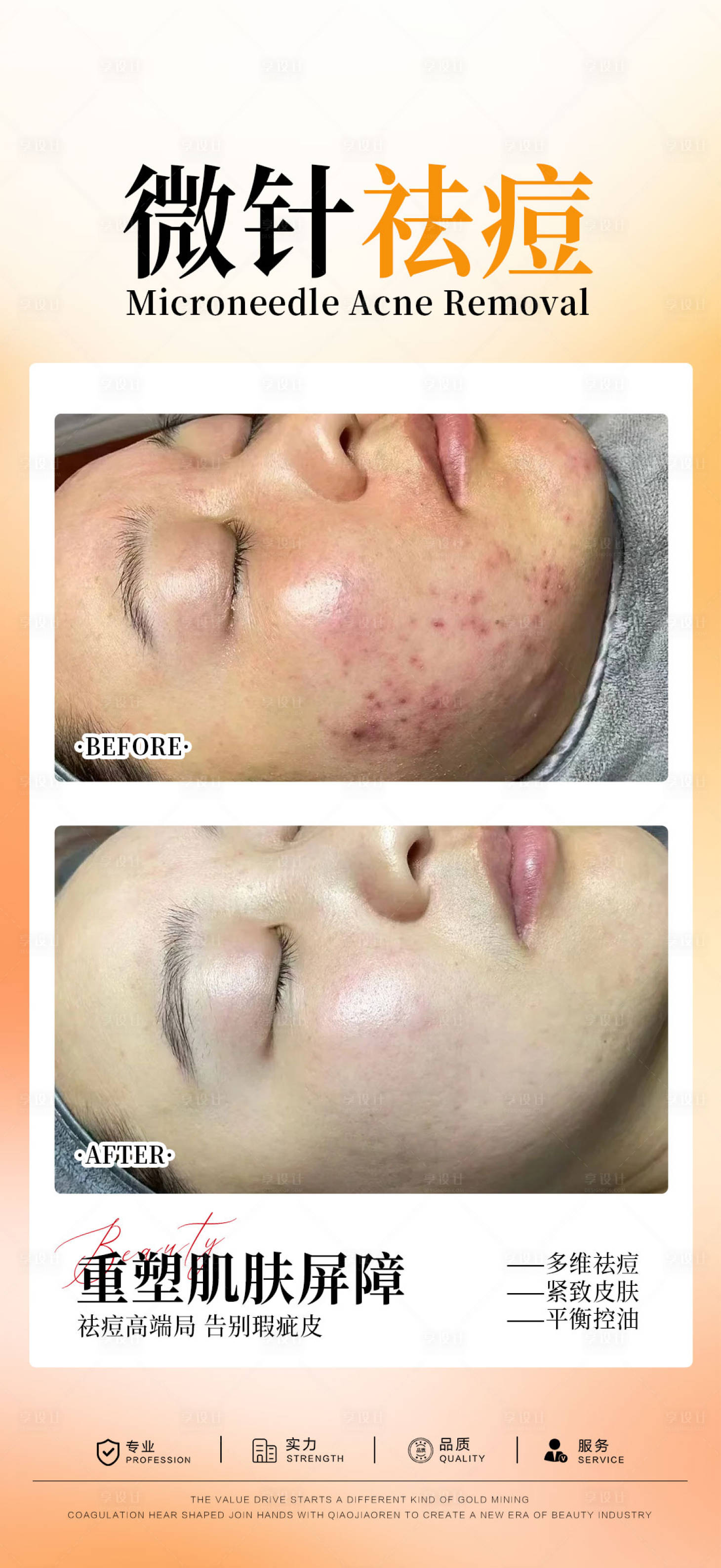 源文件下载【享设计】搜索编号：39480034197459596【微针祛痘案例海报】
