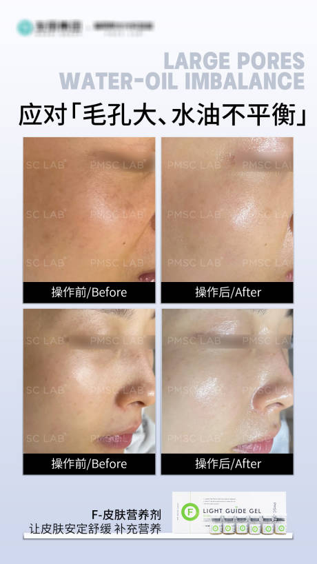 源文件下载【享设计】搜索编号：20050033833619030【毛孔粗大案例对比海报】