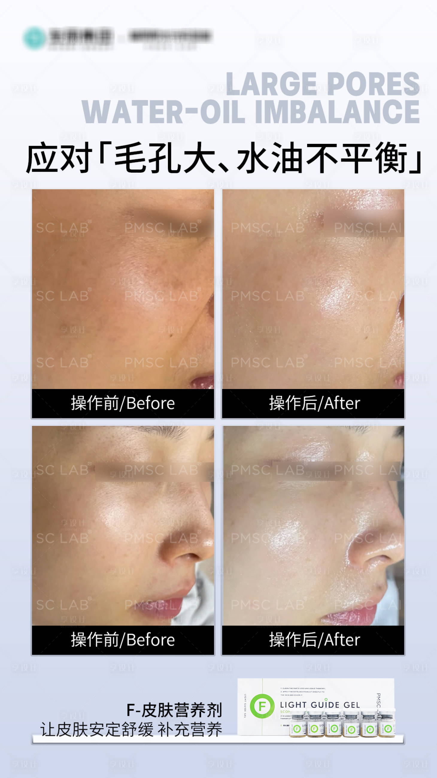 源文件下载【享设计】搜索编号：20050033833619030【毛孔粗大案例对比海报】