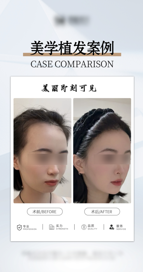 源文件下载【享设计】搜索编号：88110034635138417【医美美学植发案例海报】