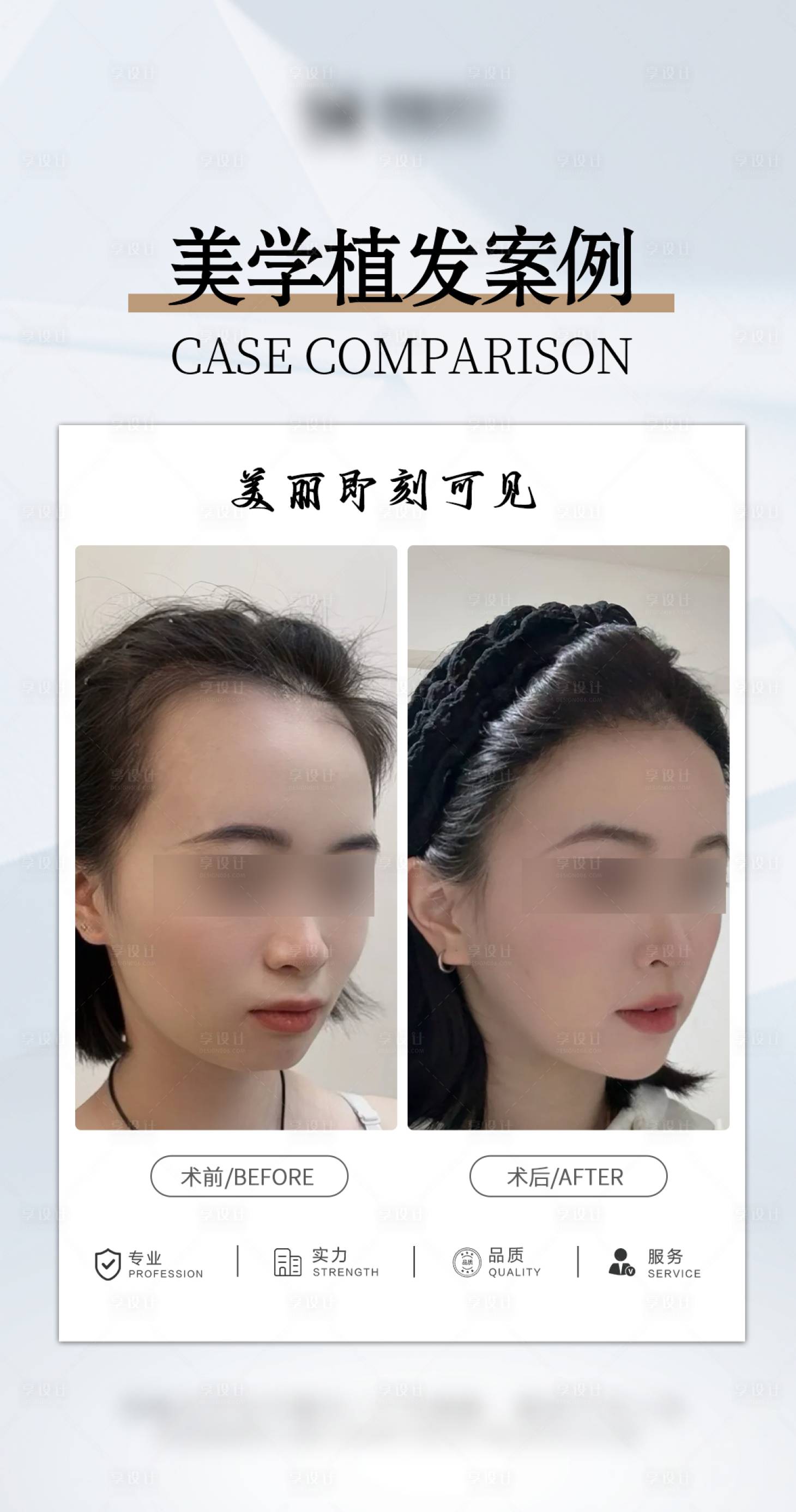 源文件下载【享设计】搜索编号：88110034635138417【医美美学植发案例海报】