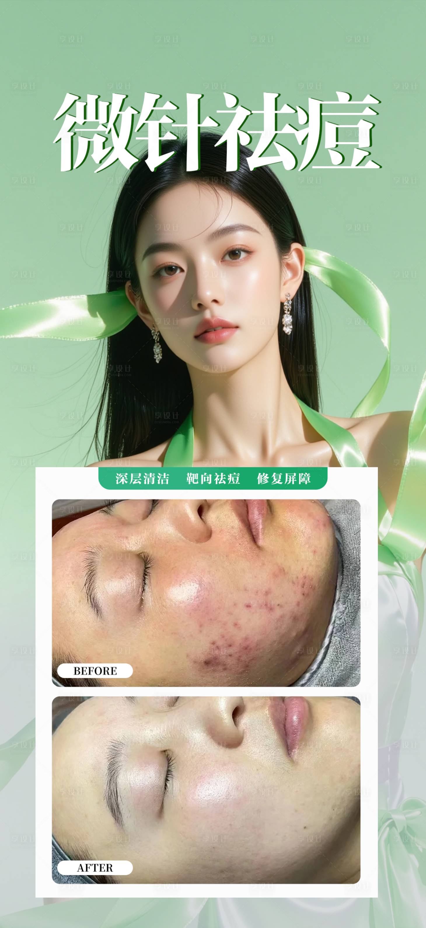 源文件下载【享设计】搜索编号：12180034290753046【微针祛痘】