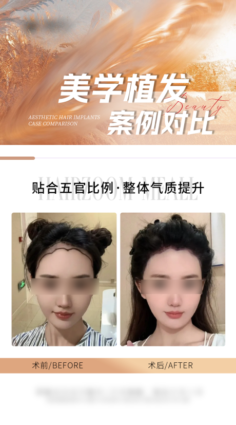 源文件下载【享设计】搜索编号：67810034542178205【医美头皮案例海报】