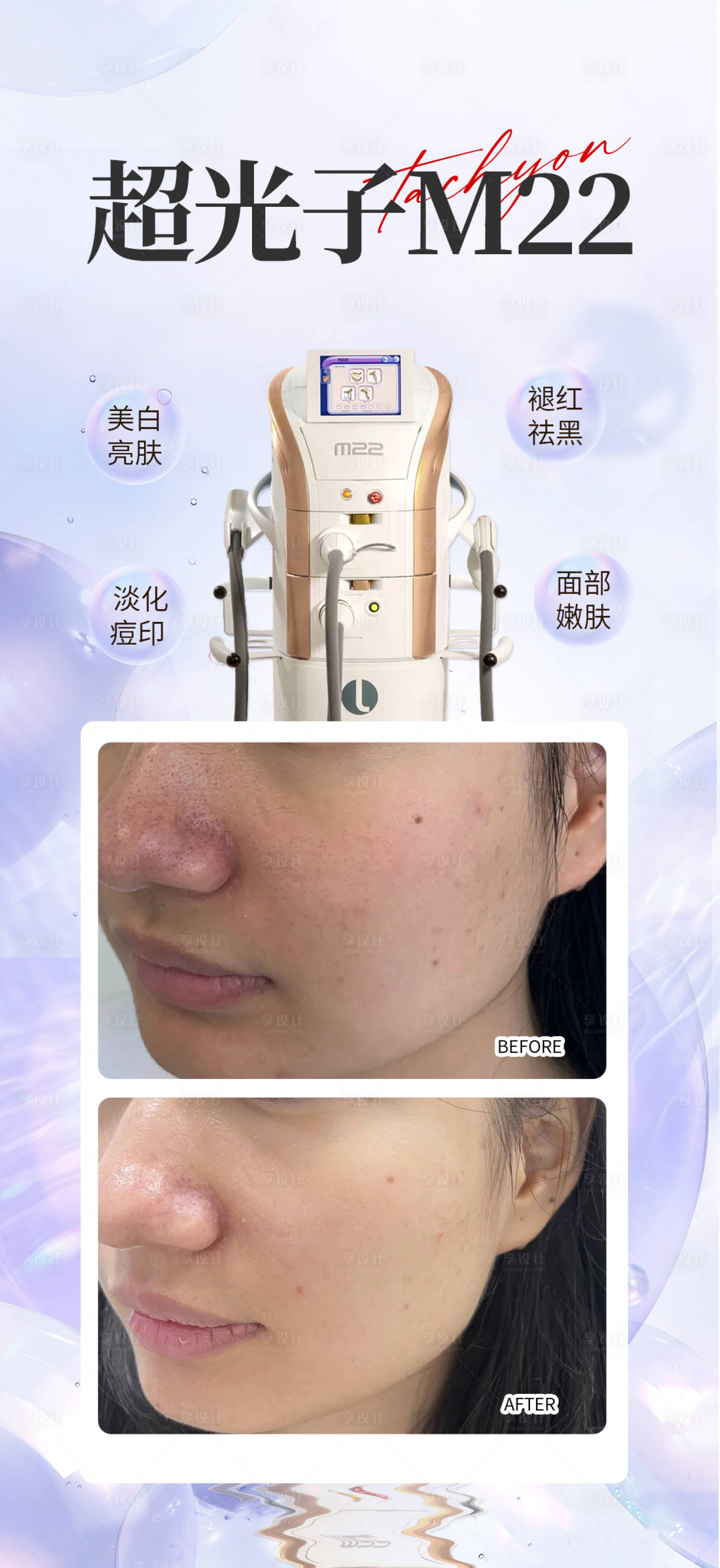 源文件下载【享设计】搜索编号：53200034631165967【光子嫩肤】